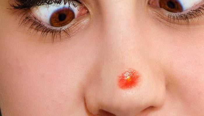 मुंहासे और दाग का इलाज - Acne and pimple Treatments in hindi