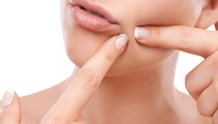 मुंहासो के प्रकार - Types of Pimples