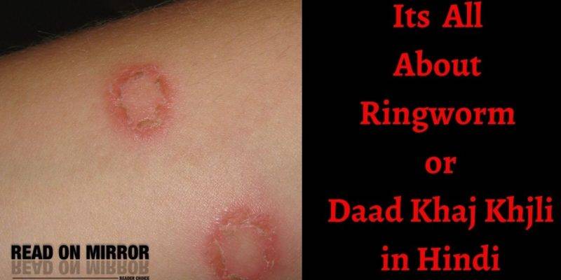 दाद खाज खुजली के 12 घरेलू उपचार, दवा और बचाव। Ringworm in Hindi