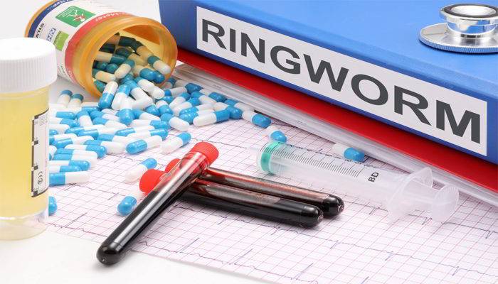 दाद होने के कारण - Causes of Ringworm in Hindi