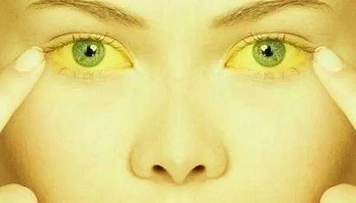 Piliya रोग होने के कारण - About Causes Jaundice in Hindi