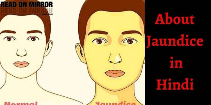 Jaundice क्यों होता है? Piliya के लक्षण, कारण, 12 उपाय और इलाज। About Jaundice in Hindi