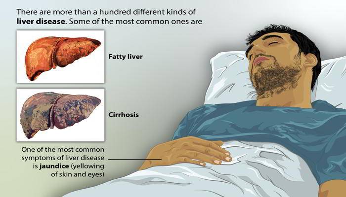 लिवर रोग के लक्षण - Disease Symptoms of Liver in Hindi