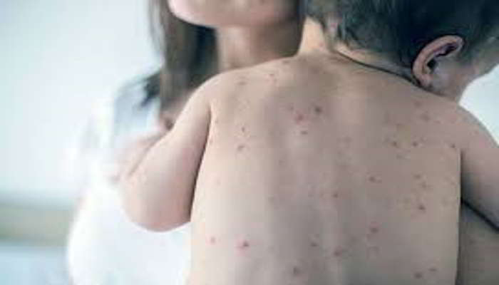 छोटी माता के लक्षण क्या हैं - Symptoms of Chicken Pox in Hindi 